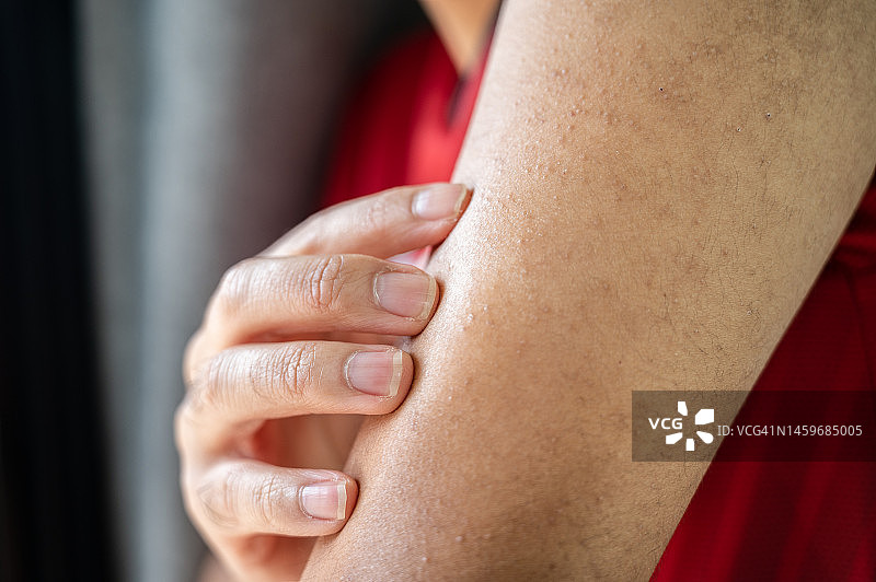 男人手臂上的毛周角化症症状特写图片素材