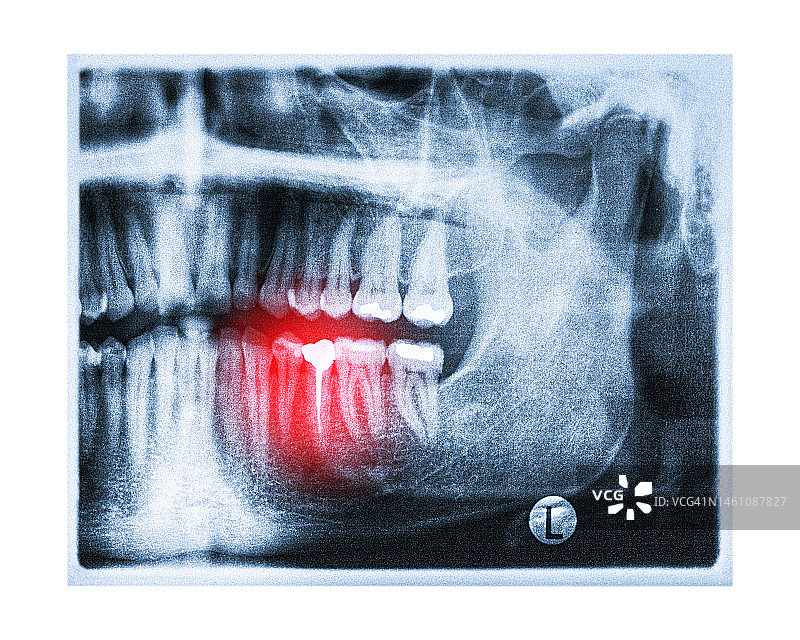 口腔X光片01图片素材