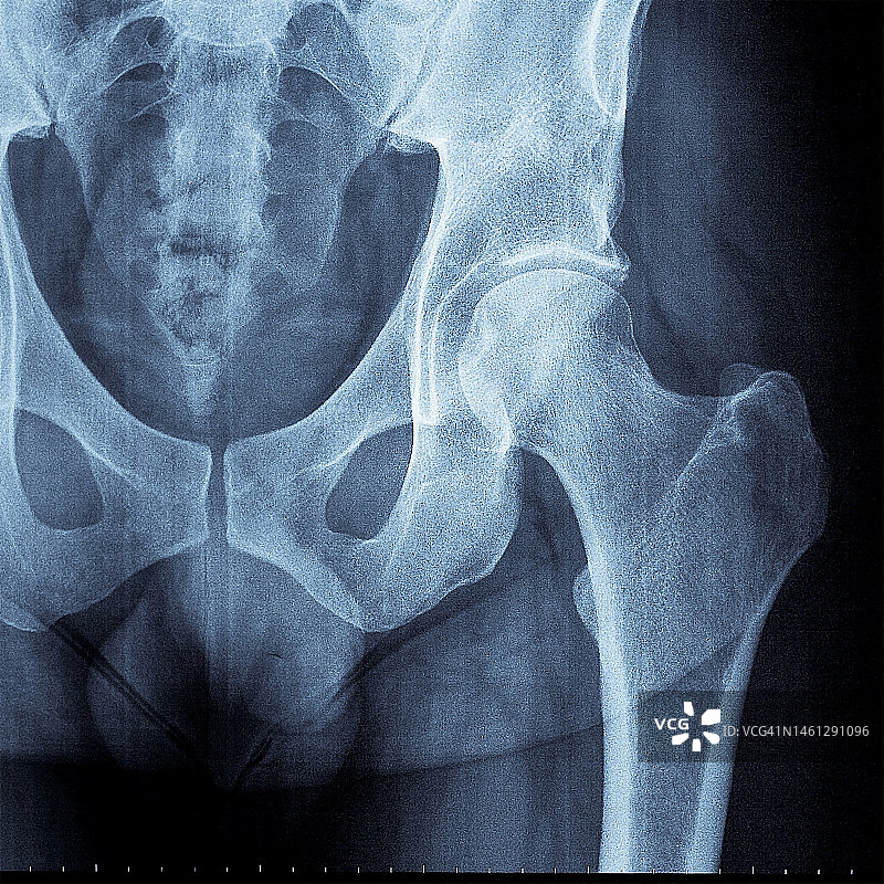盆骨X光片09图片素材