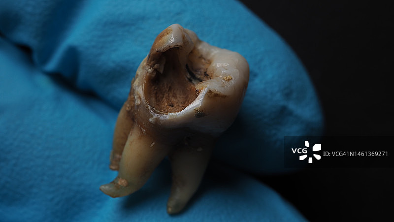 牙齿腐烂和戴手套的牙医之手（曼谷，泰国）图片素材