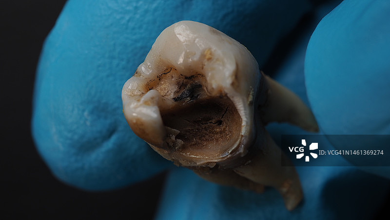 牙齿腐烂和戴手套的牙医之手（曼谷，泰国）图片素材