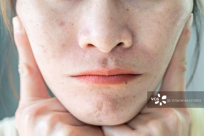 亚洲女性面部皱纹和痤疮疤痕的局部照片图片素材