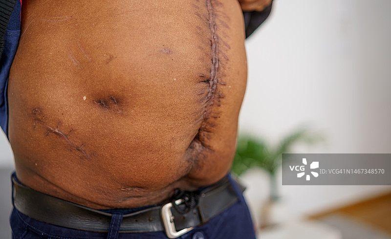 术后疤痕图片素材