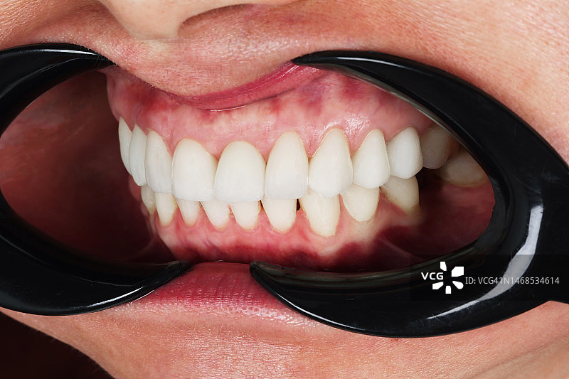 白人男子张开嘴，露出洁白的牙齿图片素材