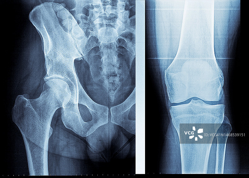 骨盆X光片 11图片素材