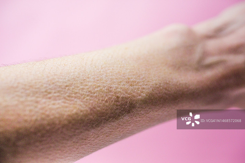手臂鸡皮疙瘩特写图片素材
