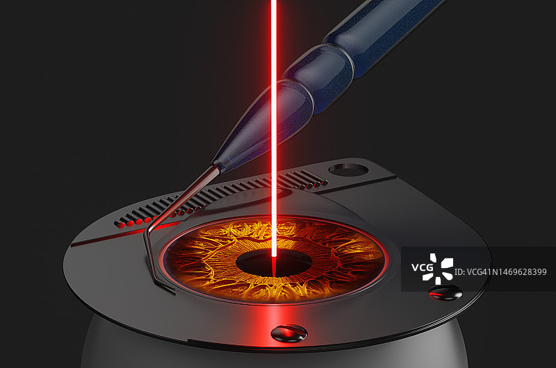 使用激光进行白内障人眼晶体摘除手术图片素材