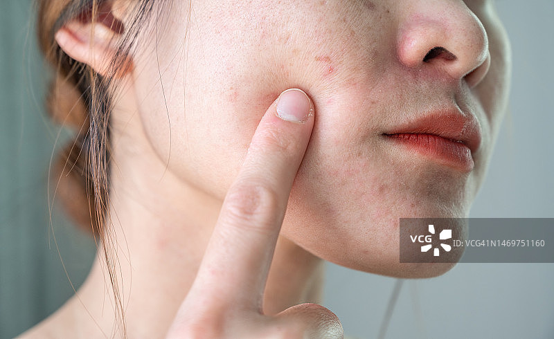 亚洲女性面部有皱纹和痤疮疤痕图片素材