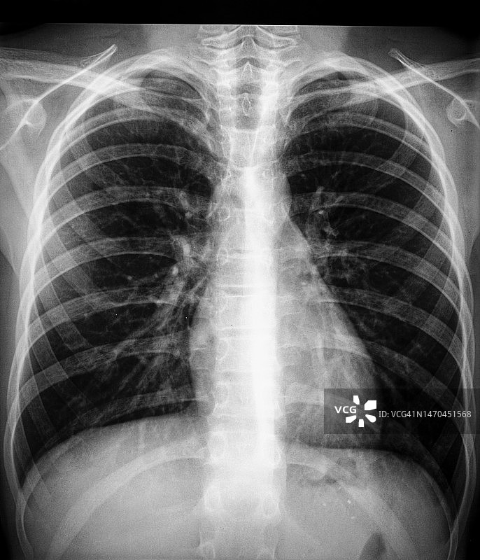 人类胸部和肺部的X光影像图片素材