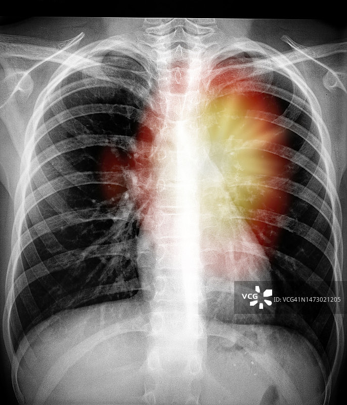 模拟疼痛的人体胸肺X光片图片素材
