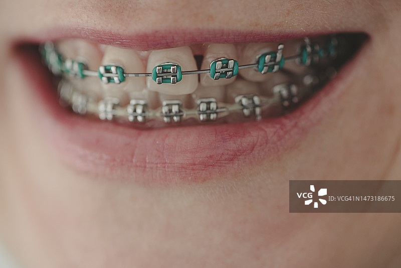 特写：女人牙齿戴着牙套图片素材