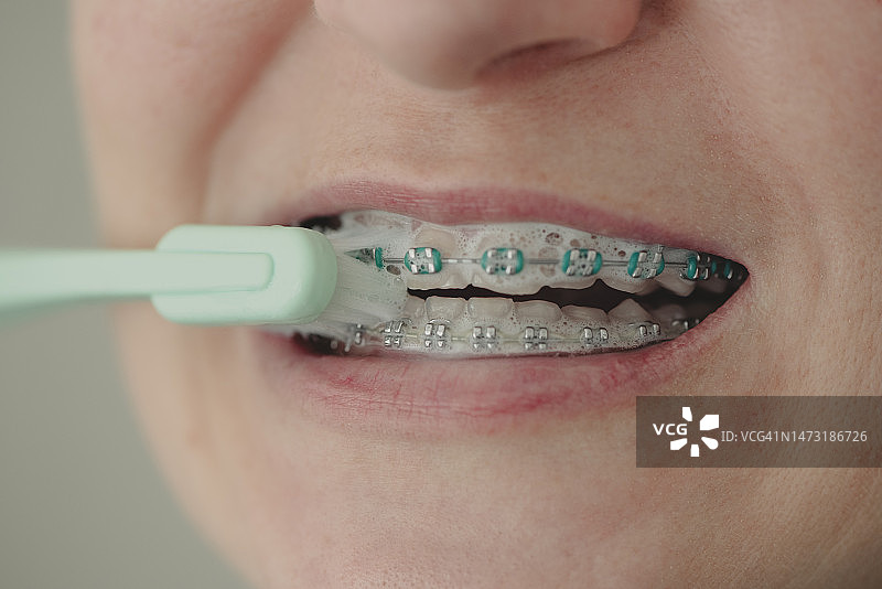 女人刷牙，用牙套刷牙图片素材