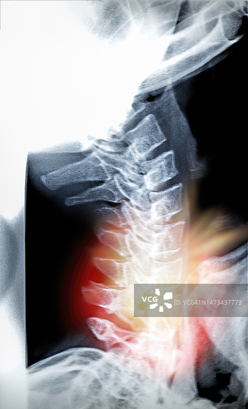 颈部疼痛患者的颈椎X光图像图片素材