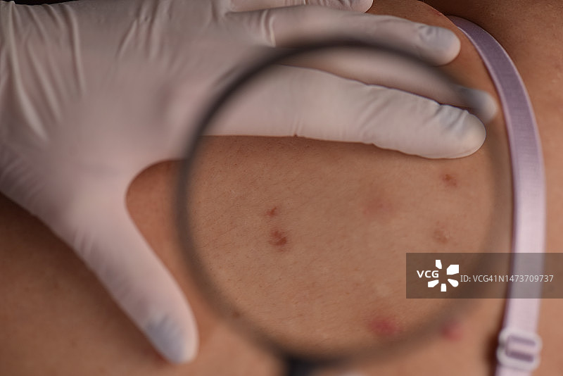 女医生检查女性背部痤疮感染皮肤图片素材