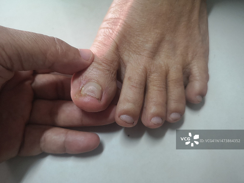 手扶脚趾，指甲患有真菌感染图片素材