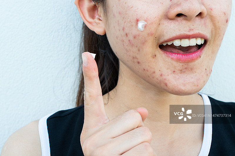 亚洲女性在脸上涂抹祛痘霜，缓解痘痘炎症图片素材