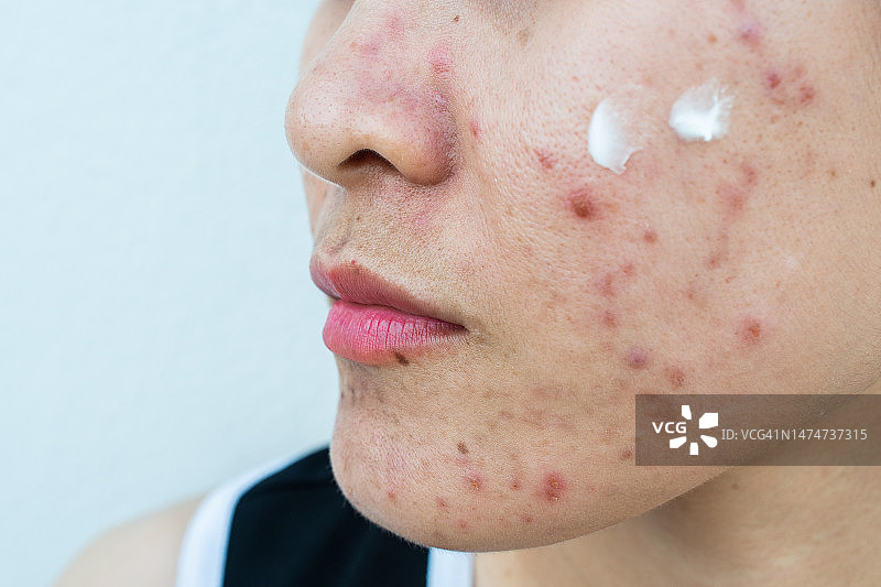 亚裔女性在脸上涂抹祛痘霜图片素材