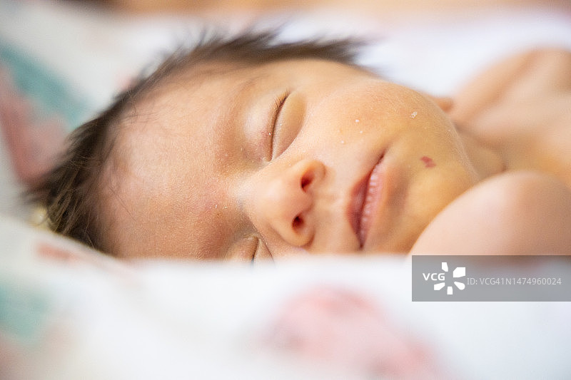 脸上长有血管瘤的新生女婴图片素材