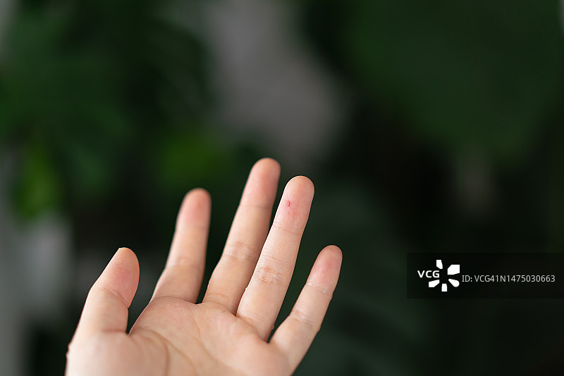 受伤的手指图片素材