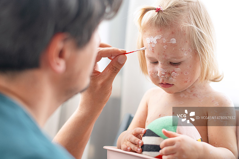 父亲在家为患有水痘的女婴涂抹药膏图片素材