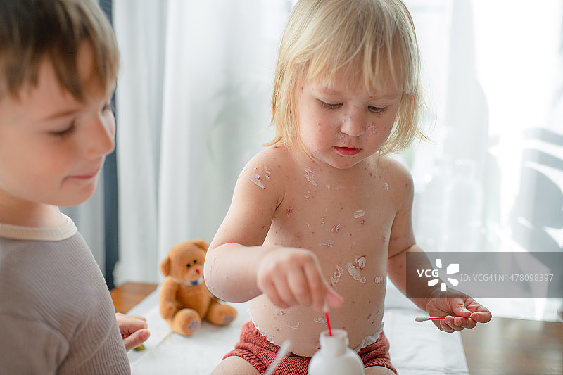 小男孩给患有水痘的生病妹妹涂抹抗菌药图片素材