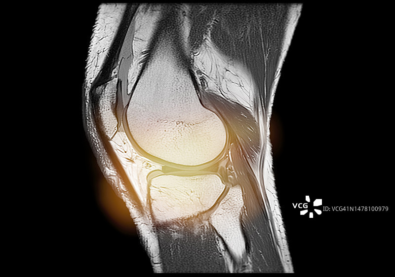 疼痛模拟下的膝盖磁共振成像图片素材