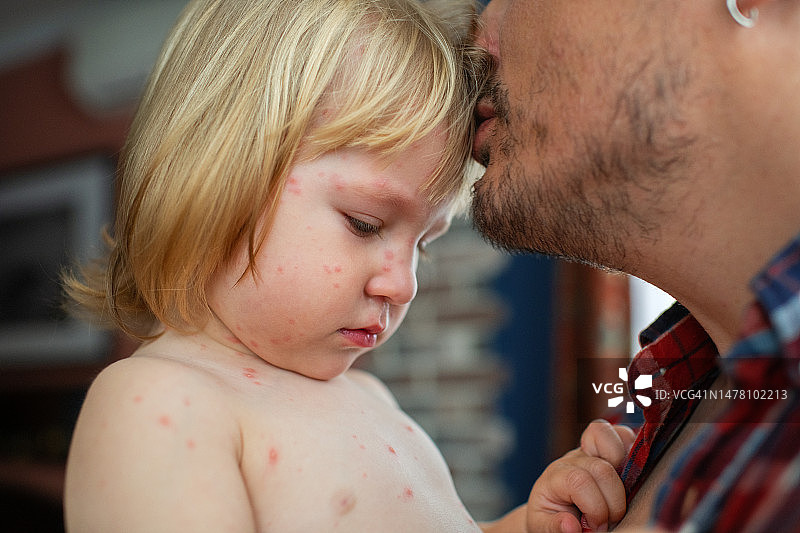父亲抱着患有水痘感染的小女儿图片素材