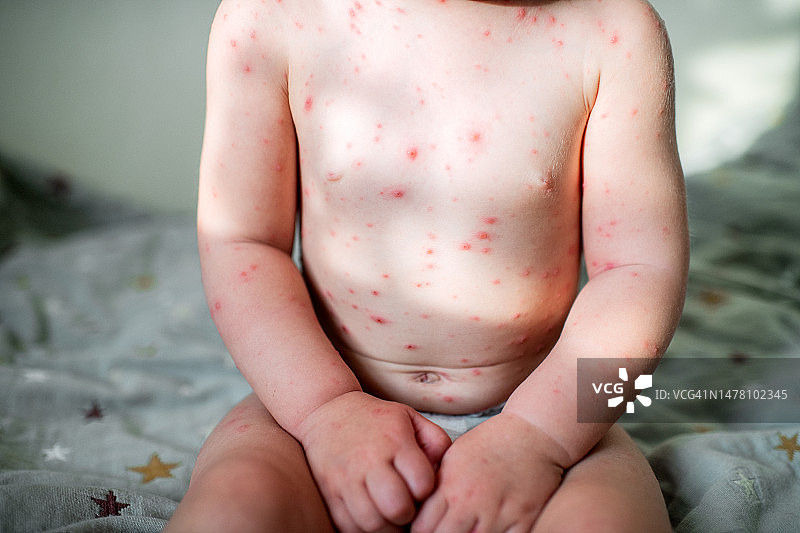 在家患水痘的小女孩图片素材