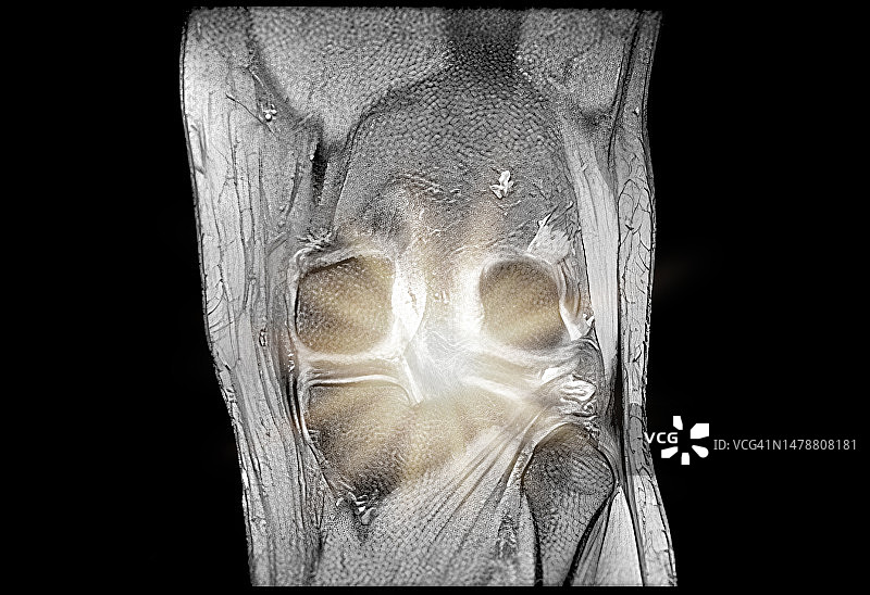 疼痛模拟下的膝盖磁共振成像图片素材