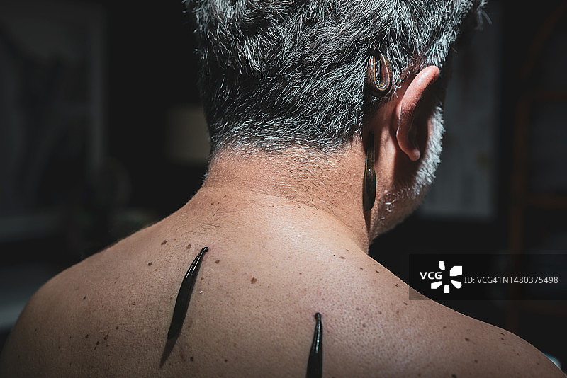 中年男人接受水蛭疗法图片素材