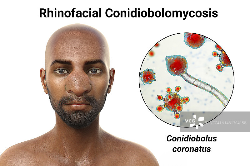 鼻面毛霉菌病和真菌插图图片素材