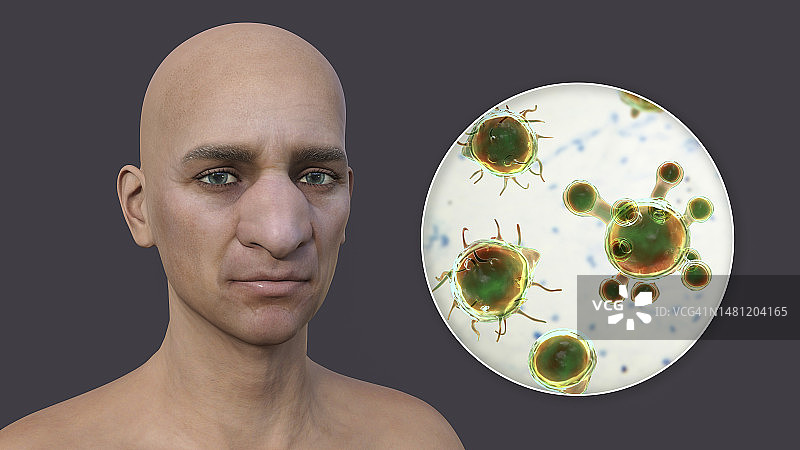 鼻面毛霉菌病和真菌插图图片素材