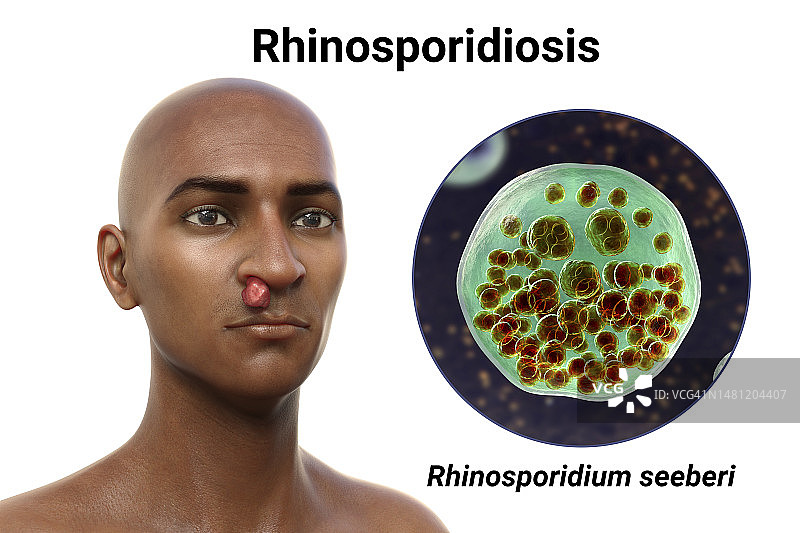 鼻鼻孢子虫病插图图片素材