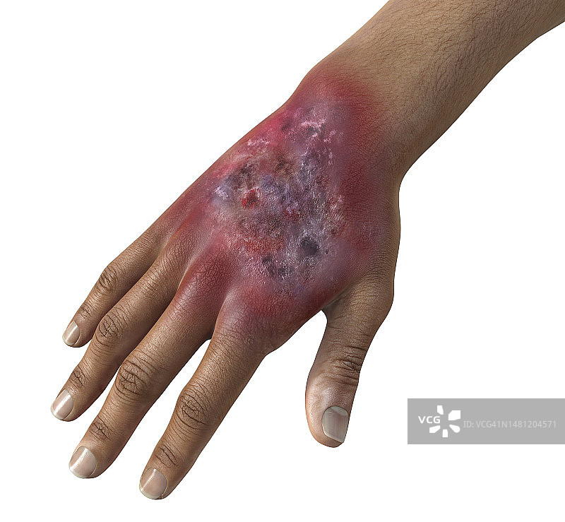 人手上感染的类酵母菌病，图示图片素材