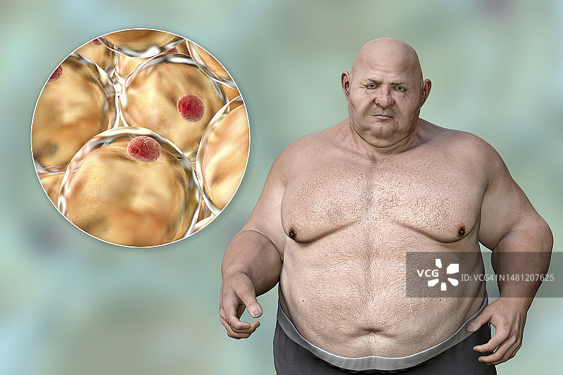 肥胖男子与脂肪细胞插图图片素材