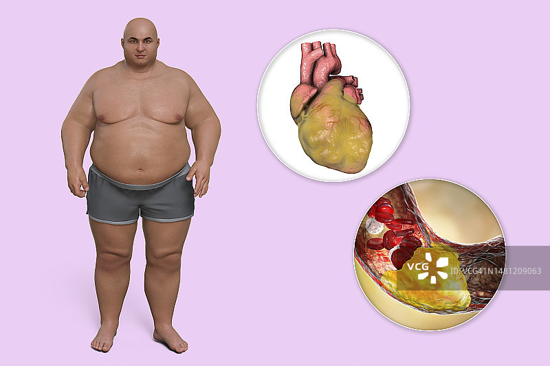 脂肪心脏动脉粥样硬化概念图图片素材