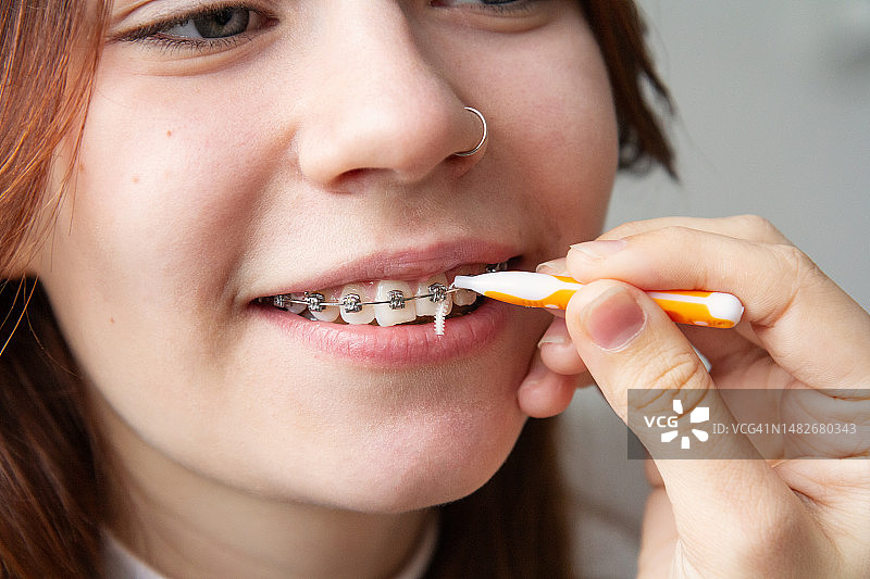 清洁牙齿矫正器特写——青少年牙齿卫生图片素材