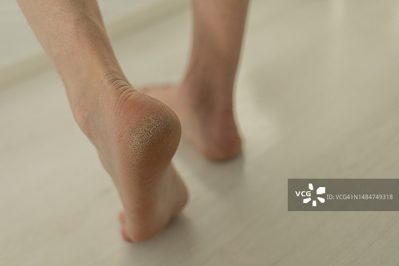 白色背景上干燥开裂的脚底图片素材