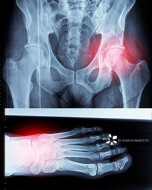 骨盆X光片07图片素材