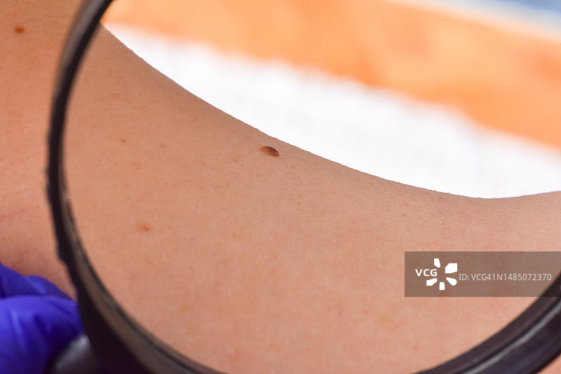 医生用放大镜检查女人背部的痣图片素材