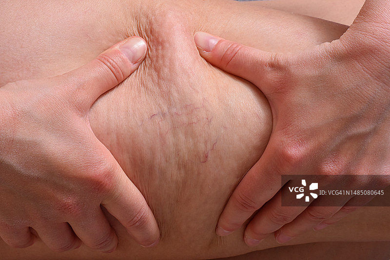 女子展示橘皮组织图片素材