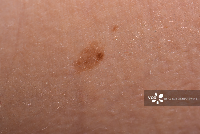 人皮肤表面的棕色痣特写照片图片素材