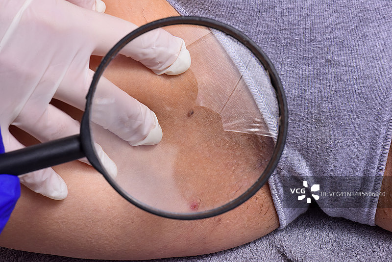 医生检查病人身上的痣图片素材