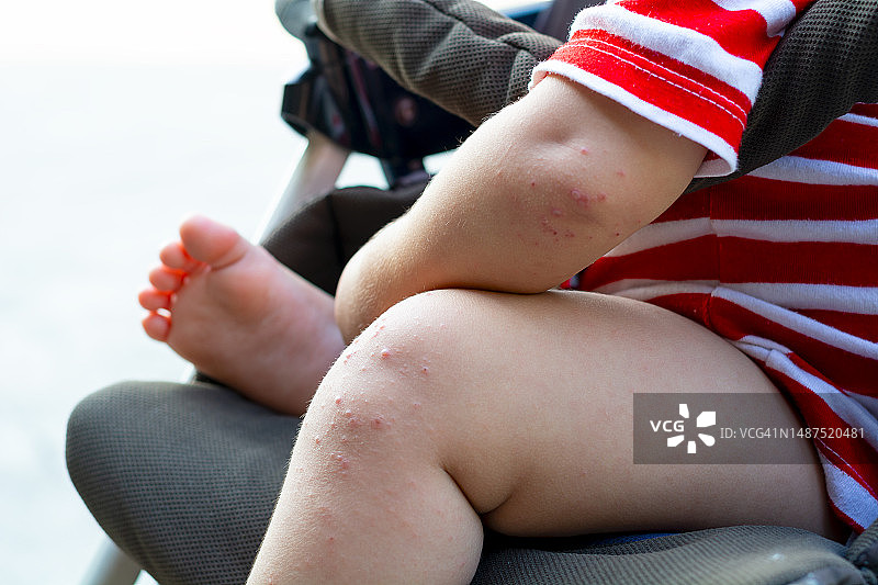 手足口病图片素材