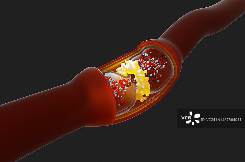 黑色背景上的静脉曲张特写：带有血栓的静脉剖面图片素材