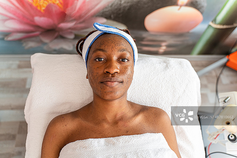 面部有痤疮疤痕的年轻女子图片素材