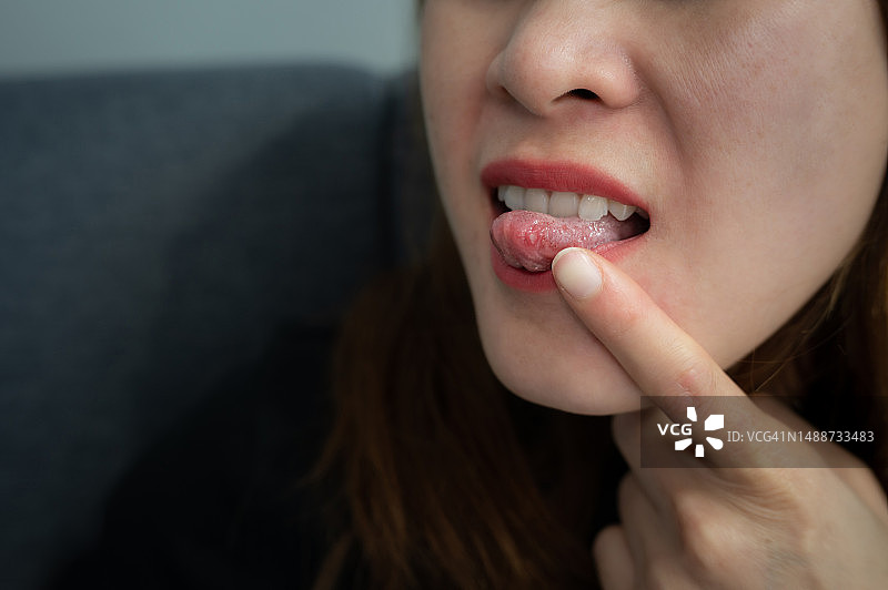 女人舌头上出现口腔溃疡的局部照片。口腔溃疡是出现在口腔内的疼痛溃疡图片素材