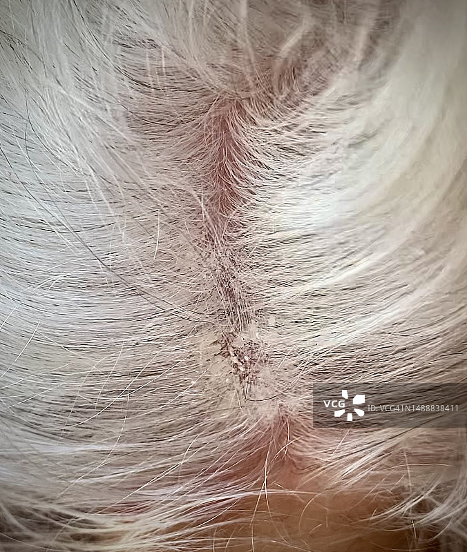 皮肤银屑病图片素材