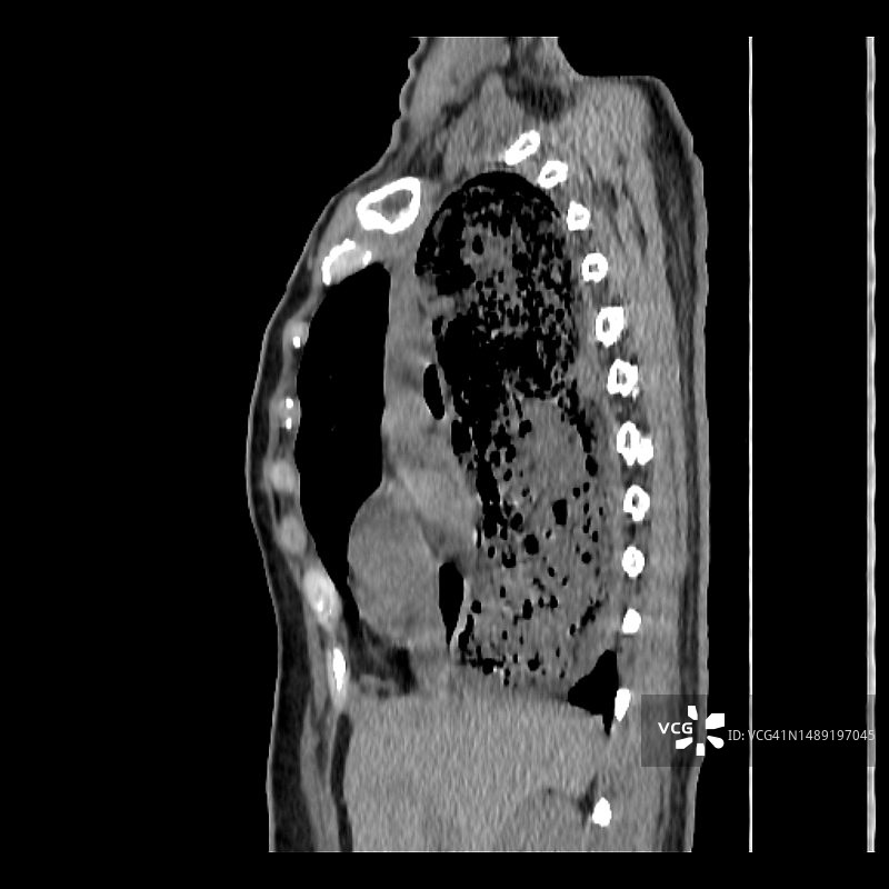 食管贲门失弛缓症CT扫描图片素材