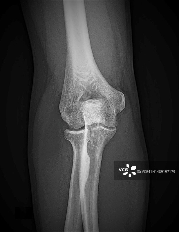 健康的肘关节X光片图片素材